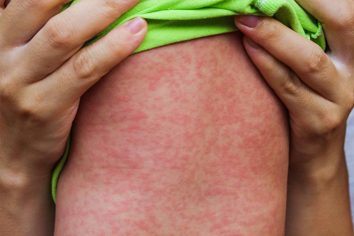 Kızamık Salgını Riski Artıyor !