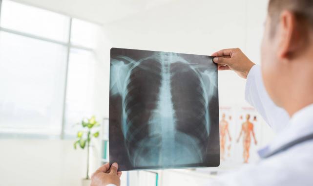 Akciğer Nakli Kimlere Uygulanabilir