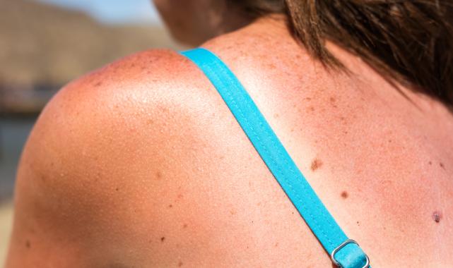 Güneş yanığına karşı 10 kritik kural