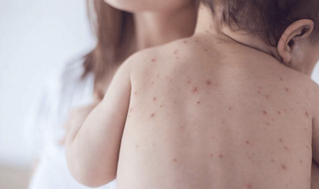 Kızamık Aşısı Nasıl Yapılmalı ?