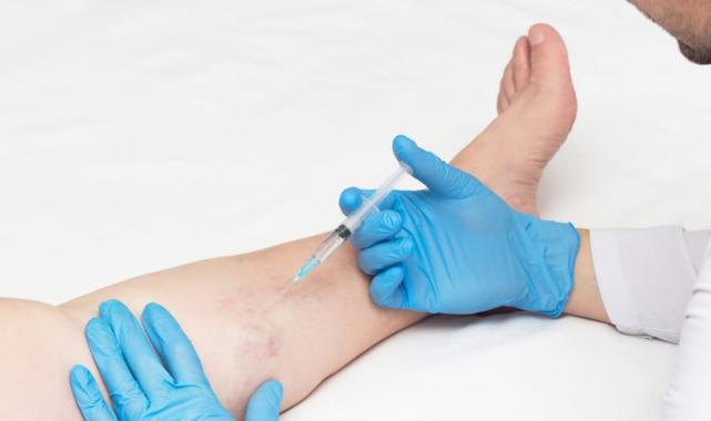 Yazın Varis Tedavisi Olur Mu?