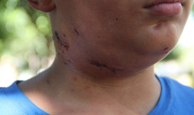 Antalya'da küçük çocuk köpek saldırısına uğradı! Boynuna 6 dikiş atıldı