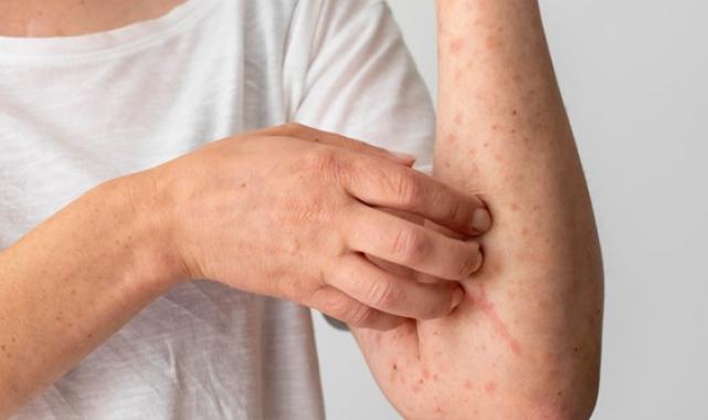 Gereksiz besin diyetleri ürtikeri tetikliyor