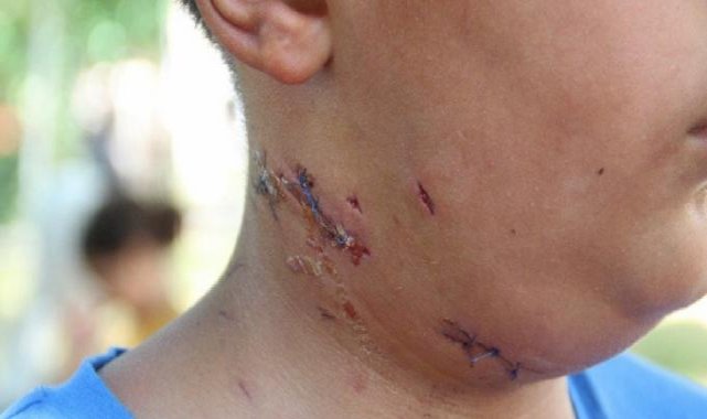 Antalya'da küçük çocuk köpek saldırısına uğradı! Boynuna 6 dikiş atıldı