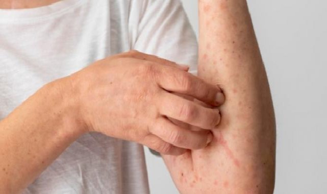 Gereksiz besin diyetleri ürtikeri tetikliyor