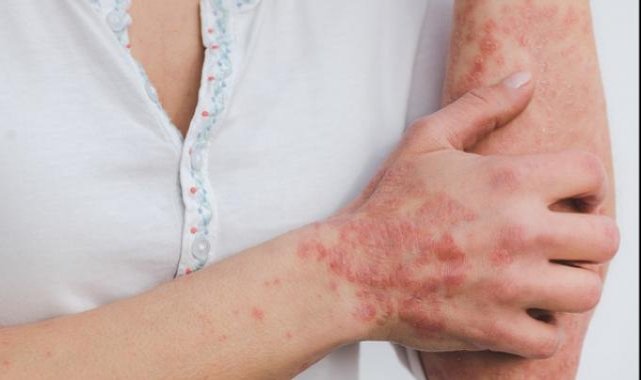 Sedef hastalığı hakkında bilinmeyenler