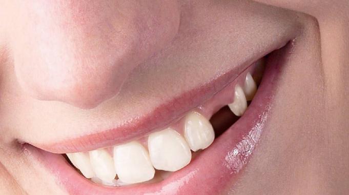 Eksik Diş Nelere Yol Açar ?