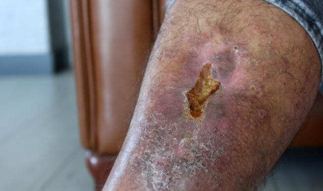 Kayseri'de bacağında unutulan bez parçasıyla 16 yıl yaşadı