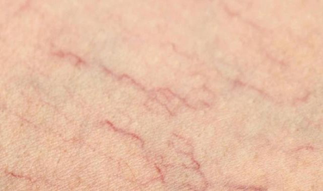 Anjiyodan kurtarıyor! Her gece 1 bardak için, damar tıkanıklığını bitirin...