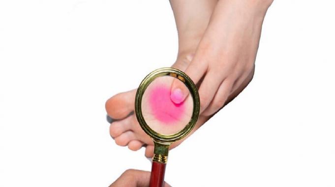 Taban ağrısının sebepleri! Topuk dikenine karşı obezite ve yanlış ayakkabıya dikkat...