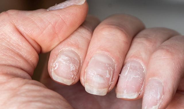 Tırnaklarınız uyarıyor! Eğer tırnaklarınızda bunlar varsa hasta olabilirsiniz...