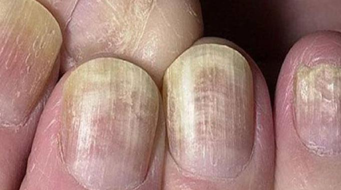Tırnaklarınız uyarıyor! Eğer tırnaklarınızda bunlar varsa hasta olabilirsiniz...