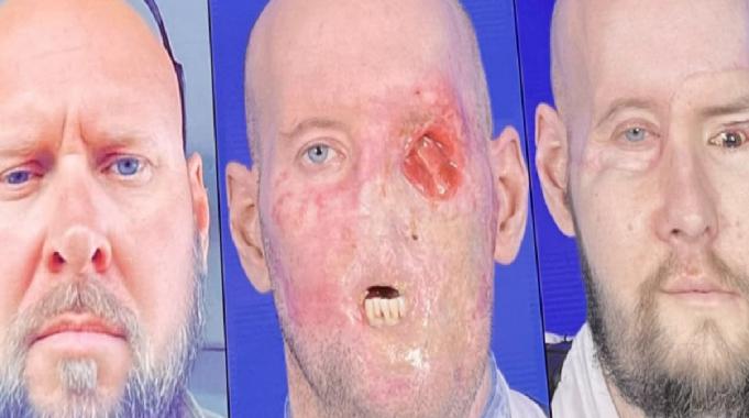 Dünyada bir ilk: Tam göz ve kısmi yüz nakli yapıldı