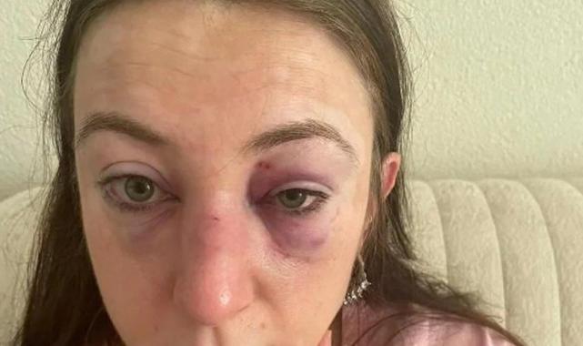 Bursa'da eski sevgilisini zorla arabaya bindirip kaçırdı, 9 kez kafa attı