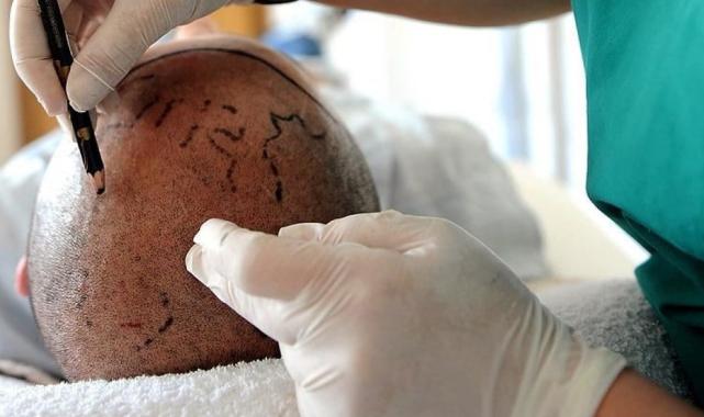 Uzmanlar uyardı: Saç ektirecekler, kliniğin ruhsatını kontrol etsin