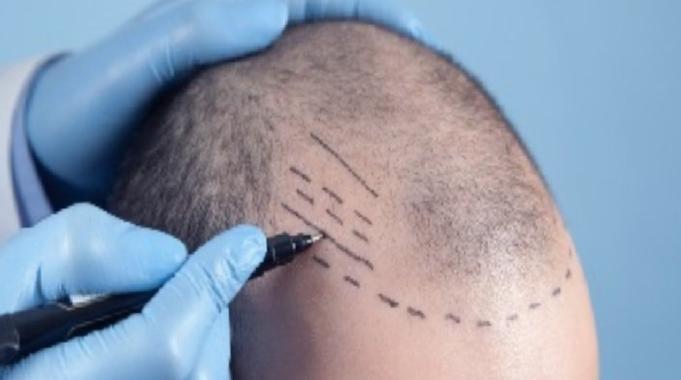 Uzmanlar uyardı: Saç ektirecekler, kliniğin ruhsatını kontrol etsin