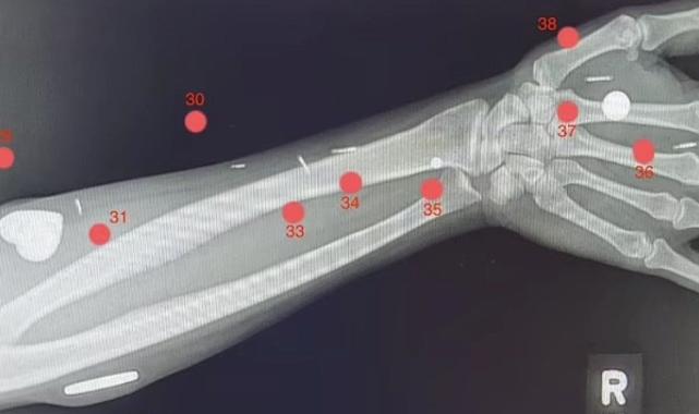 Vücudundaki 52 çiple dünya rekoru kıran kadın: Anastasia Synn