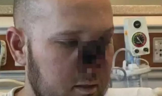 ABD'de grip olan adamın hayatı karardı: Burnunu aldırmak zorunda kaldı