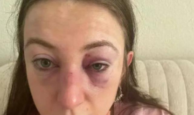 Bursa'da dehşeti yaşattı: Eski sevgilisi vücudunda sigara söndürdü