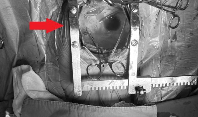 Ekin Ada'nın minik kalbini söktüler, tümörü temizleyip yerleştirdiler