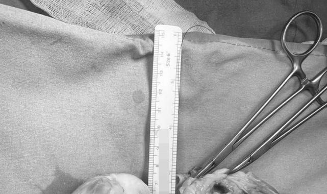 Ekin Ada'nın minik kalbini söktüler, tümörü temizleyip yerleştirdiler