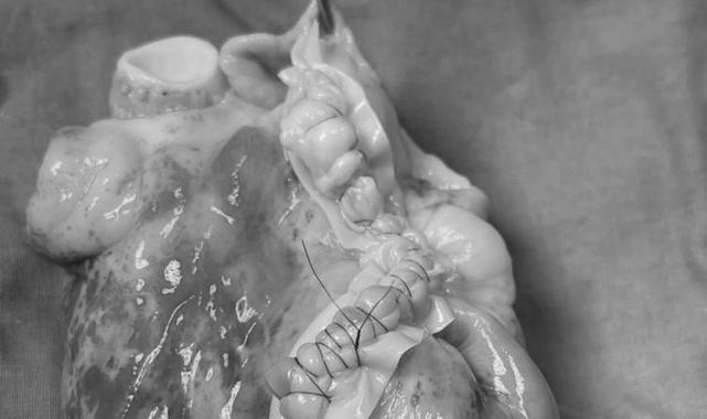 Ekin Ada'nın minik kalbini söktüler, tümörü temizleyip yerleştirdiler