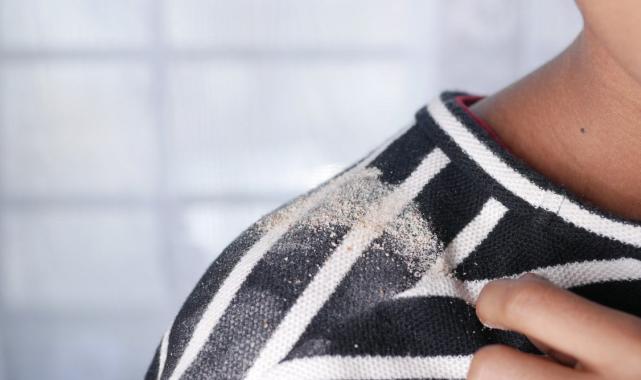 Saçta kepek sorununa kökten çözüm! Şampuanınıza 3 adet eklemeniz yeterli...