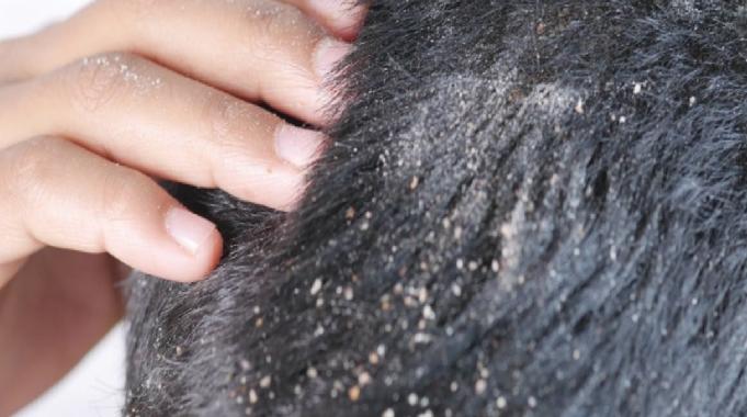 Saçta kepek sorununa kökten çözüm! Şampuanınıza 3 adet eklemeniz yeterli...