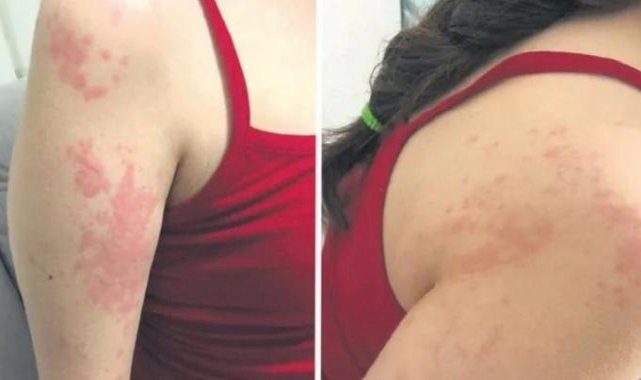 Kocaeli'de hasta kızına verilen ilaç, alerjiye neden oldu