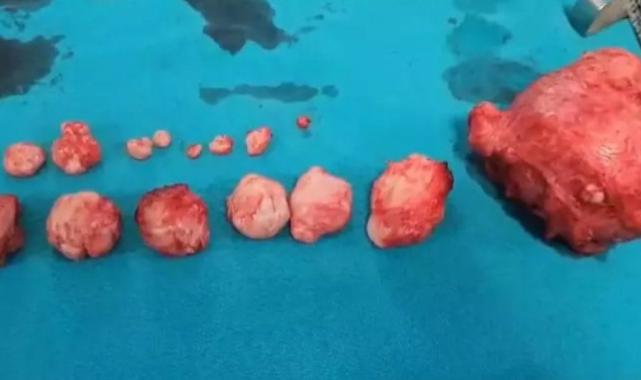 Ankara'da doktorları şaşırtan olay! Karın ağrısı diye gitti, tümör çıktı