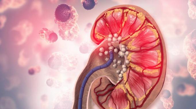 Böbrek Taşıyla Mücadelede Doğru ve Yanlışlar