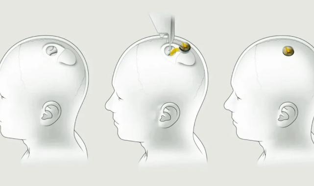 Elon Musk'ın beyin çipi Neuralink hacklenirse ne olur