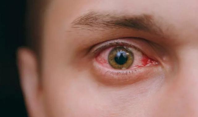 Göz nezlesi kabusunuz olmasın! Hem kış hem bahar aylarının belası: İşte detaylar