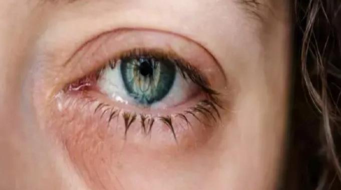 Göz nezlesi kabusunuz olmasın! Hem kış hem bahar aylarının belası: İşte detaylar