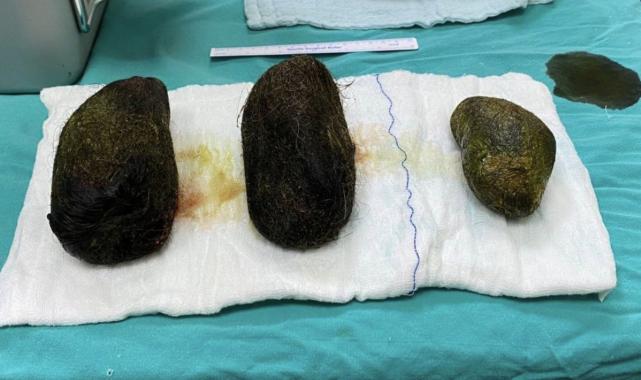 Osmaniye'de karın ağrısı şikayetiyle hastaneye gitti midesinden 2 kilo saç çıktı