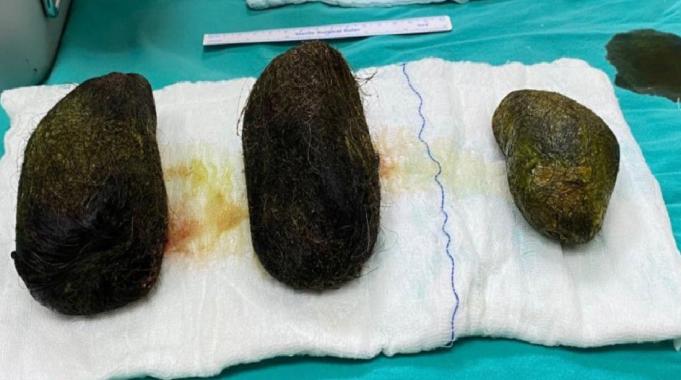 Osmaniye&#039;de karın ağrısı şikayetiyle hastaneye gitti midesinden 2 kilo saç çıktı