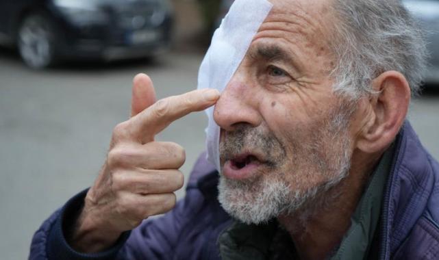 Sinop'ta korkunç hastalık: 65 yaşındaki adamın yüzü eriyor