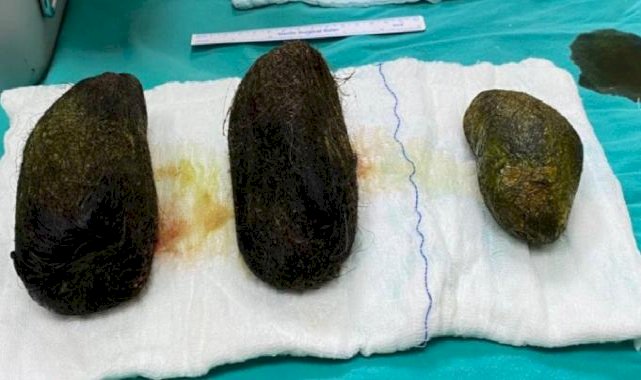 Osmaniye'de karın ağrısı şikayetiyle hastaneye gitti midesinden 2 kilo saç çıktı