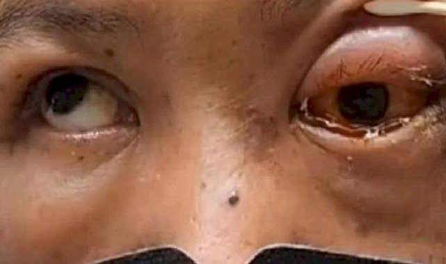 Tayvan'da şaşırtan olay: Sarhoşken yüzüstü uyuyan adam kör uyandı