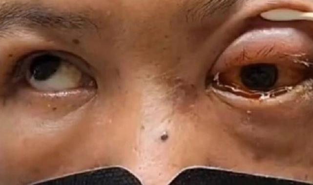 Tayvan'da şaşırtan olay: Sarhoşken yüzüstü uyuyan adam kör uyandı