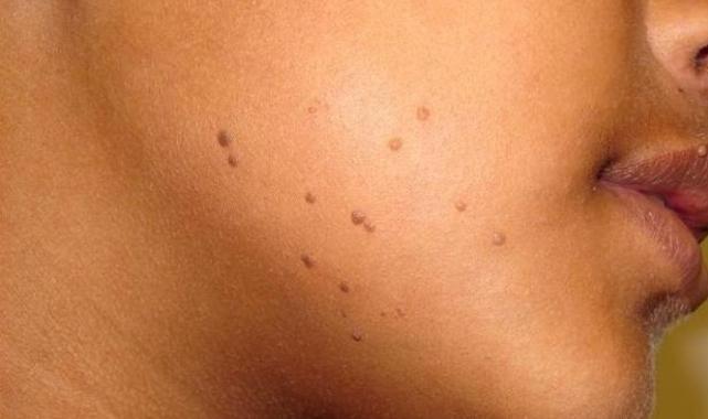 İşte yüzünüzdeki benlerin çoğalma nedeni