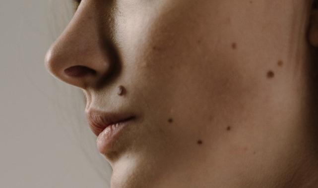 İşte yüzünüzdeki benlerin çoğalma nedeni