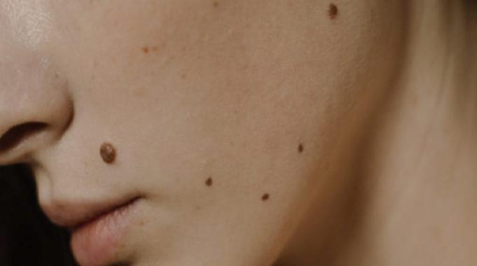 İşte yüzünüzdeki benlerin çoğalma nedeni