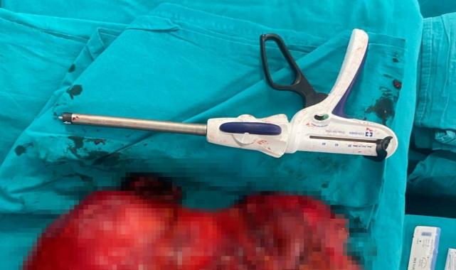 Antalya'da karın ağrısı tümör çıktı