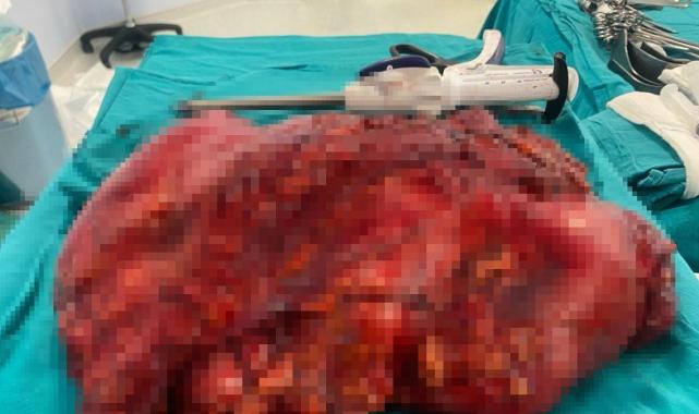 Antalya'da karın ağrısı tümör çıktı