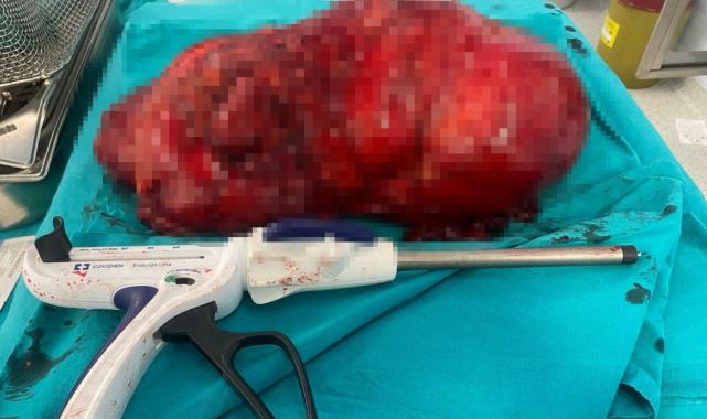 Antalya'da karın ağrısı tümör çıktı