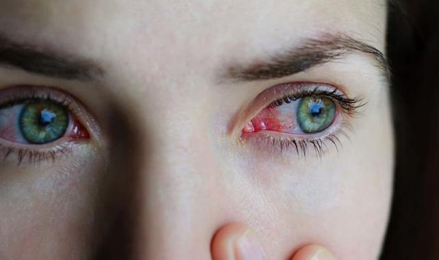 Baharın habercisi: Göz alerjisi belirtileri neler? Nasıl tedavi edilir?