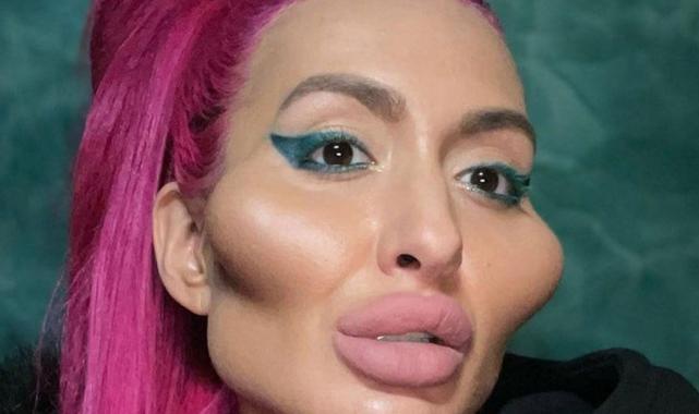 Estetiksiz halini gören şaştı kaldı! Bakın dünyanın en büyük yanaklı kadınının estetiksiz hali nasılmış…