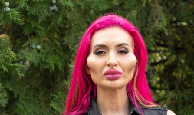 Estetiksiz halini gören şaştı kaldı! Bakın dünyanın en büyük yanaklı kadınının estetiksiz hali nasılmış…