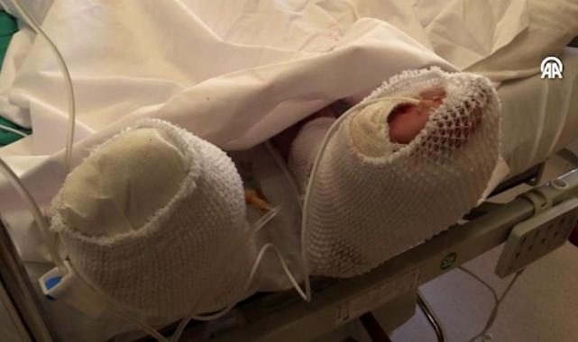 Rize'de benzin bidonu patladı vücudu yandı: Olayın etkisinden kurtulamıyorum